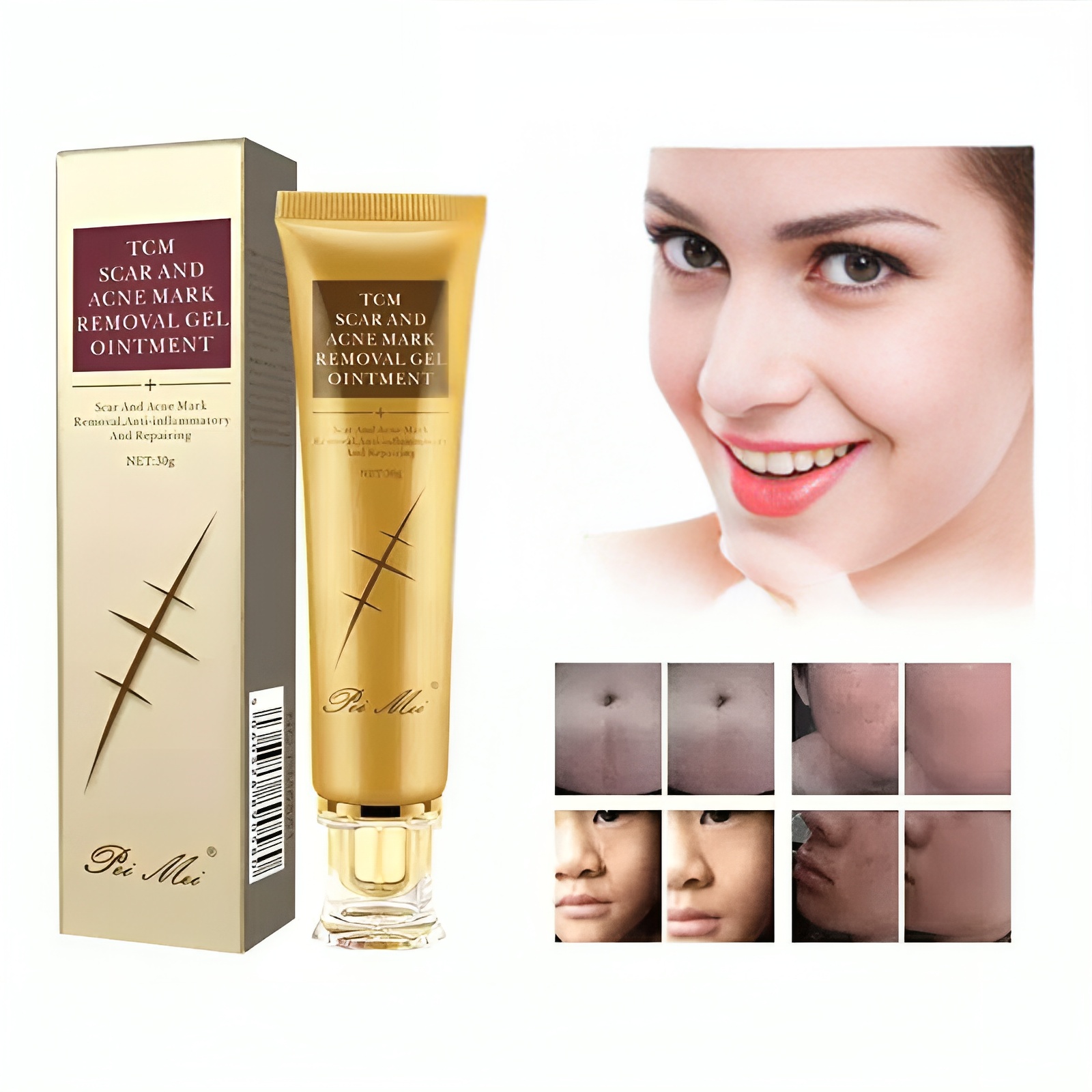 Scar and ACNE Mark Removal Gel Ointment – 30 g